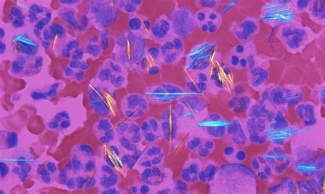 Gout Vs Pseudogout Crystals