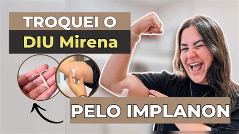 Tirei O Diu E Coloquei Implanon Minha Experi Ncia Youtube