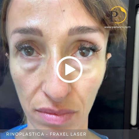 Rinoplastica Video Pallaoro Medical Laser