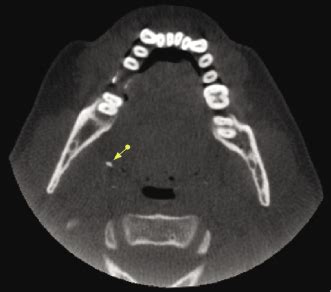 Detection Of Incidental Findings In Cone Beam Computed Tomography