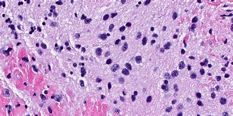 Pathology Outlines Diffuse Low Grade Glioma Mapk Pathway Altered