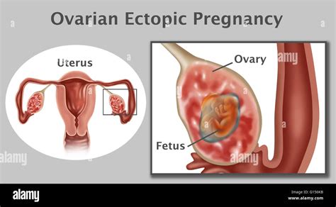 Ilustración De Un Embarazo Ectópico Ovárico Este Es Un Tipo De