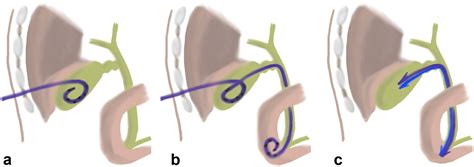 Percutaneous Cystic Duct Interventions and Drain Internalization for ...