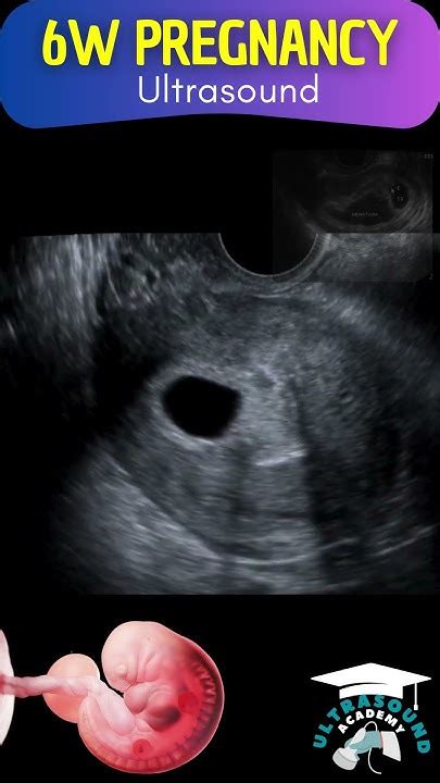 Early Glimpse 6 Week Pregnancy Ultrasound Revealed In 30 Seconds Youtube