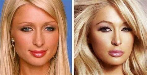 Celebrity Blepharoplasty Before And After 10 Celebrities That Have Had