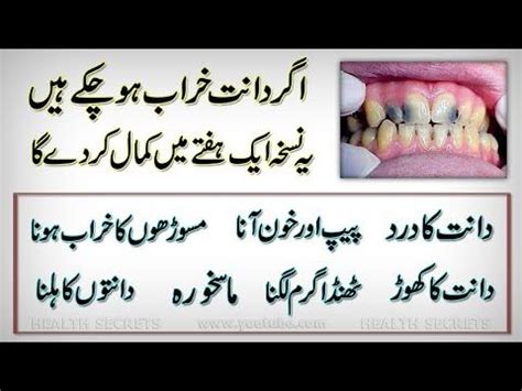 Pin By Muhmmad Hussain On Munaza In 2020 Cavity Treatment Teeth Care