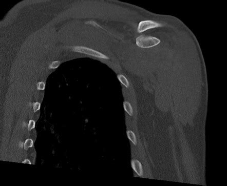 Posterior Shoulder Dislocation With Lesser Tuberosity Fracture Image