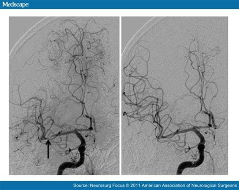 Intracranial arteriosclerosis; Cerebral Arteriosclerosis; Intracranial ...