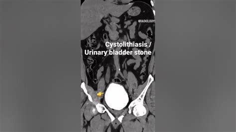 Cystolithiasis #radiology #bladderhealth - YouTube