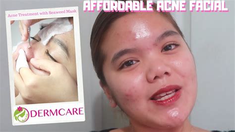 Affordable Acne Facial Treatment Dermcare Youtube