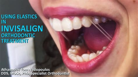 Using Elastics In INVISALIGN Treatment Athanasios Tom Nasiopoulos