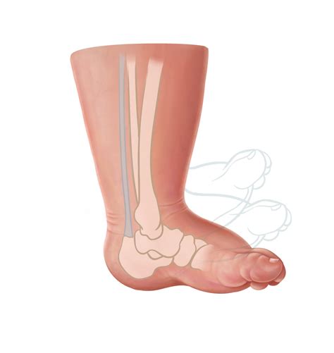 Emma Scheltema Illustration - Clubfoot Tenotomy for Starship Child Health