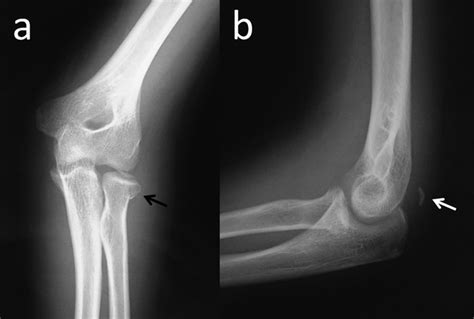 Avulsion Fracture Elbow