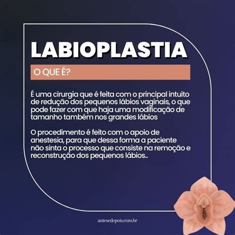 O Que É Labioplastia - Labioplastia: Antes e depois e Valor