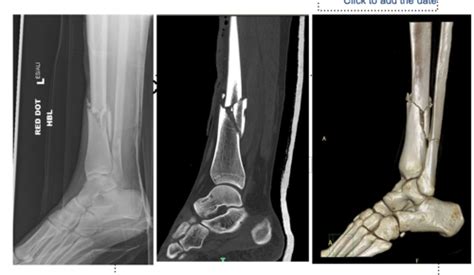 Management Of Specific Fractures Flashcards Quizlet