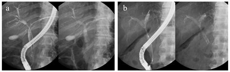 JPM Free Full Text Endoscopic Transpapillary Stenting For Malignant