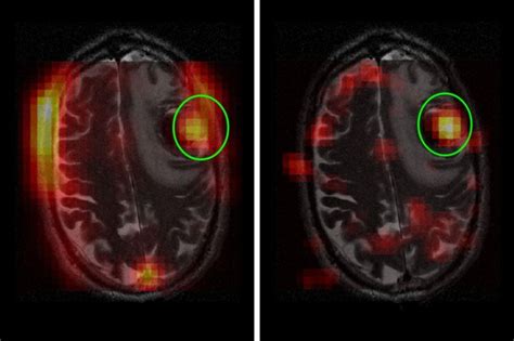 Brain Mri Tumor