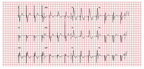 Pacemakers A Beginners Guide Geeky Medics