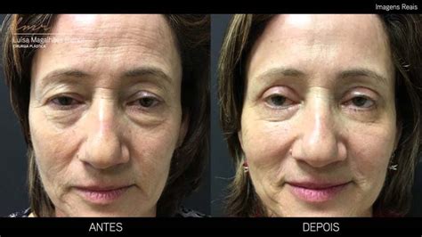 Blefaroplastia É cara Como é feita e como é a recuperação