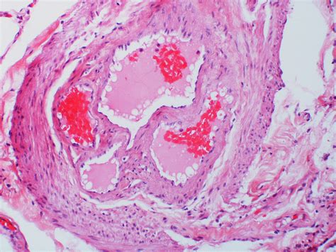 Complete Organization Of Thromboembolus With Recanalization A Photo On Flickriver