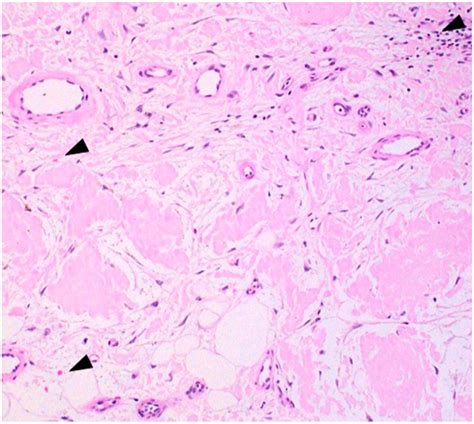 Dermatoscope Of Primary Localized Cutaneous Nodular Amyloidosis On