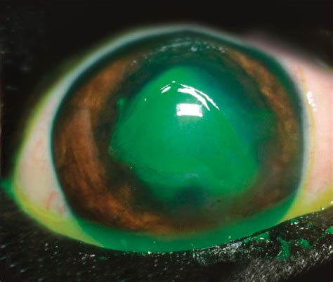 Recurrent Corneal Erosions Indolent Ulcers Ndsr