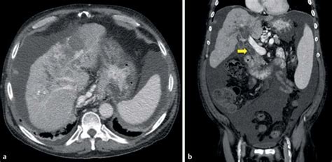 Ct Scan A The Ct Scan Revealed Cirrhosis Hcc Portal Vein Thrombosis