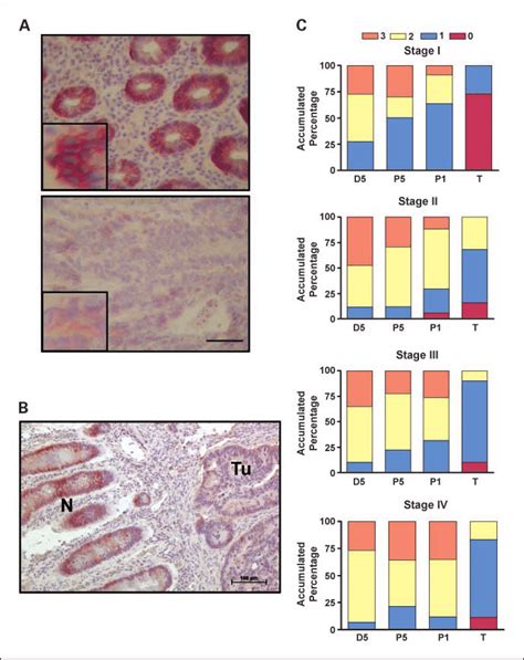 Immunohistochemical Staining Of CD151in Paired Colon Tissue And Colon