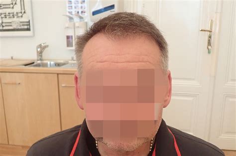 Haartransplantation Vorher Nachher Dr Stiefsohn