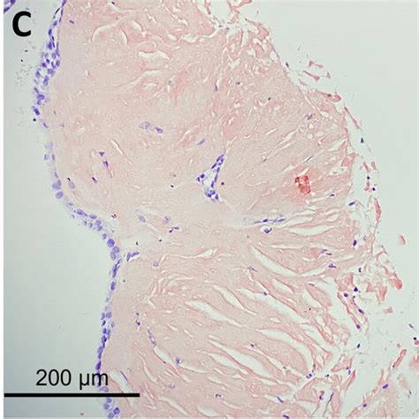 A B Slit Lamp Photograph Showing Yellowish Calcified Plaques Of Both