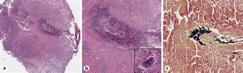 Histopathologic findings diagnostic of botryomycosis. a Scan showing... | Download Scientific ...