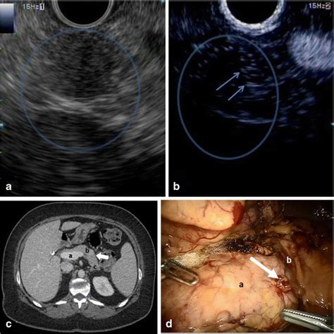 Endoscopic Ultrasonography Of The Pancreas Demonstrating The