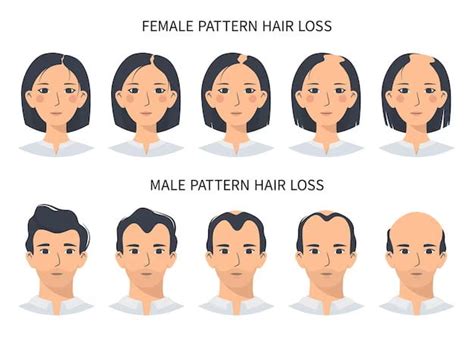 Androgenetic Alopecia Male And Female Pattern Baldness Hairfree And Hairgrow