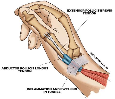De Quervain’s Tenosynovitis - North Texas Orthopedic & Spine Center