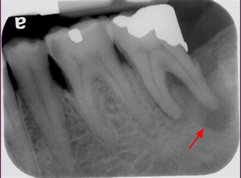 Impact of iatrogenic dentistry on oral health | Suji Kang DHDP2014 ...