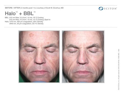 Fox Valley Plastic Surgery Halo™ Laser Treatments