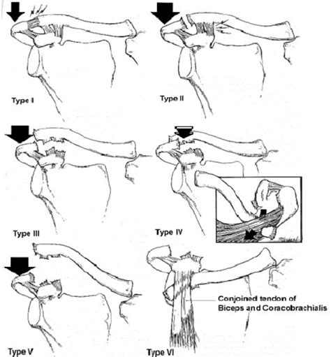 Ac Joint Sprain Grades