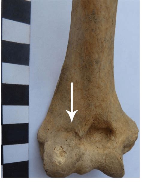 Radial fossa on the distal end of the humerus. | Download Scientific Diagram