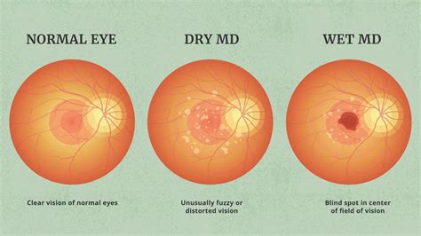 Navigating Wet Macular Degeneration Diagnosis Treatment And Support