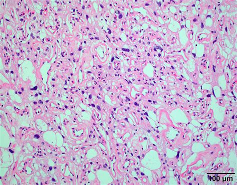 Meningioma Histology