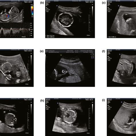 Color Ultrasonography Of The Fetus A Color Ultrasonography Of The