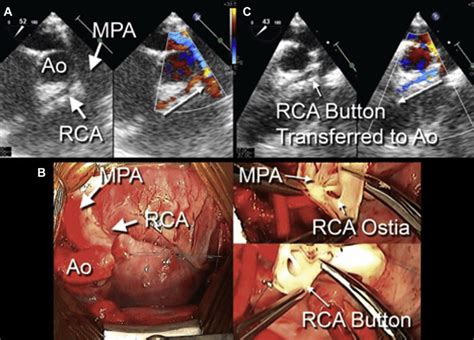 Preoperative Transthoracic Echocardiogram Shows Flow Reversal In The