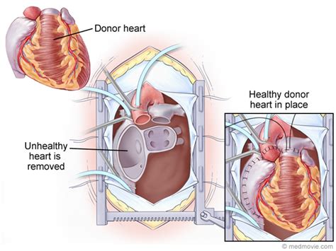 heart transplantation