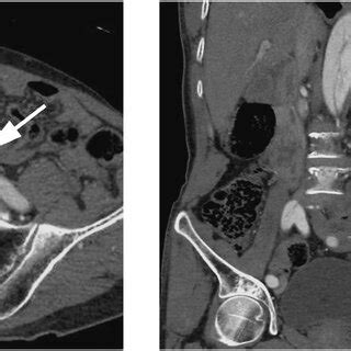 A Year Old Man With Stanford Type B Double Barreled Aortic