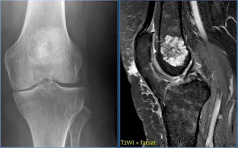 Chondrosarcoma Mri