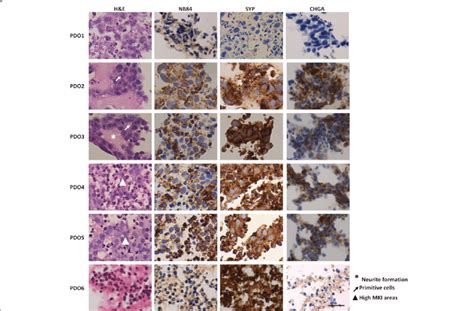 Histological Analysis Of NB PDOs Histological Examination Was