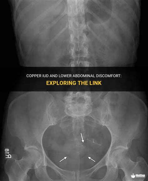 Copper Iud And Lower Abdominal Discomfort: Exploring The Link | MedShun