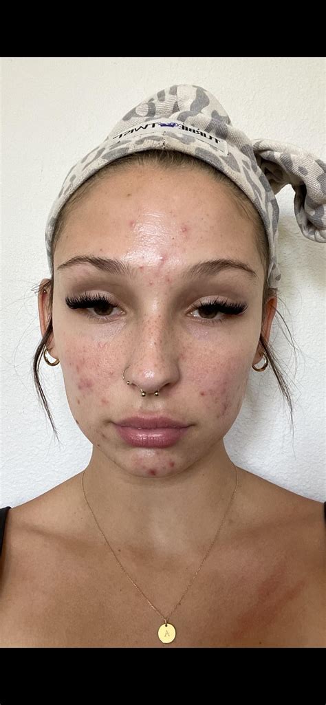 Day 1 Vs Day 95 R Accutane