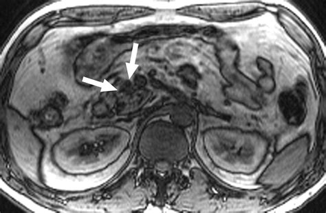 Focal Fatty Replacement Of The Pancreas Usefulness Of Chemical Shift