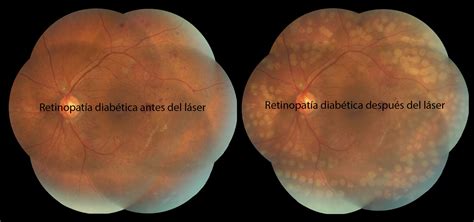 Fotocoagulación con Láser oftalmologoencancun drmontero